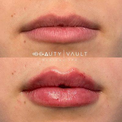 Lip Filler Before & After Beauty Vault Med Spa in West Hollywood, CA