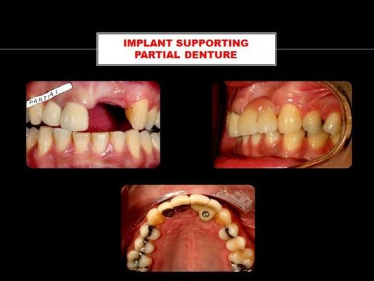 CASE 2979: Implant partial denture