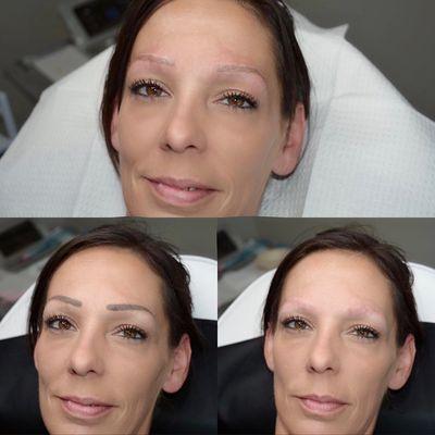 Do to chemotherapy, she lost ALL her eyebrow hairs.
The top picture is the Hairstroke Technique.