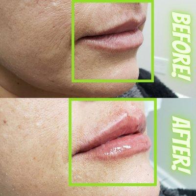 Lip filler can help plump up your volume!