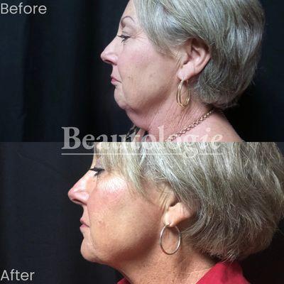 Kybella Before and After by Dr. Milan Shah