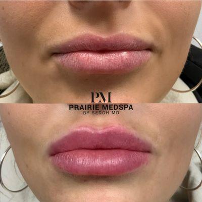 Lip enhancement at Prairie Medical Spa