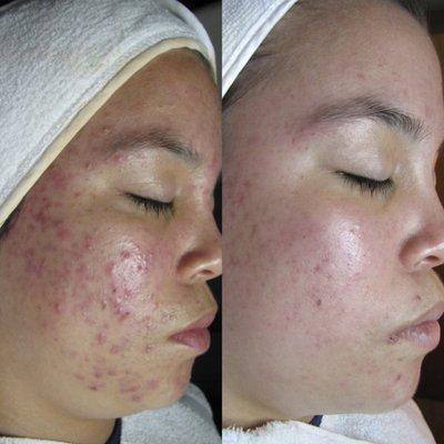 Before and after on acne program four months appart!