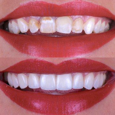 Porcelain Veneers for a Smile Makeover