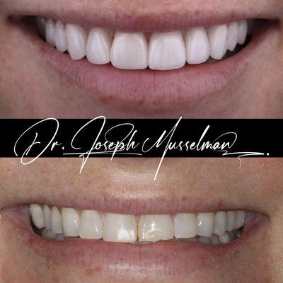 Beautiful smile makeover using minimal prep porcelain veneers.