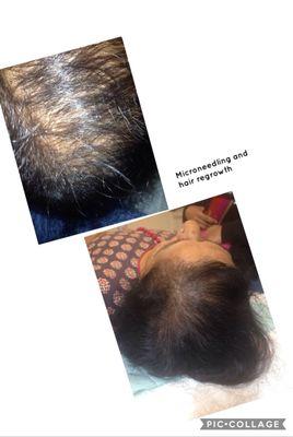 Hair Restoration by Microneedling Folsom CA