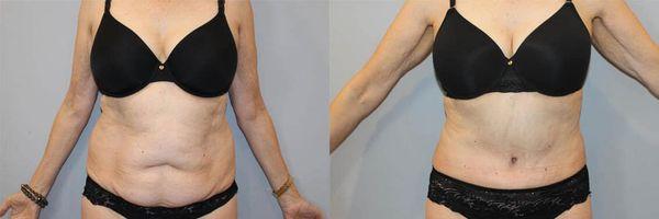 Tummy Tuck (abdominoplasty) by Dr. David Feldmar | Feldmar Aesthetics