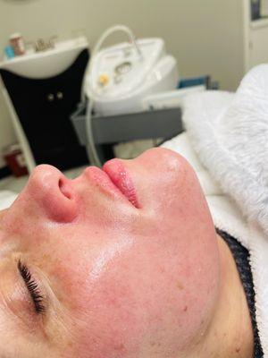 Microdermabrasion/ light chemical peel/ lip Enhancement using micro needling Naturally plumps creating new collagen