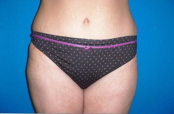 Tummy tuck (abdominoplasty)After