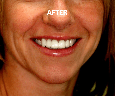 Smile change - AFTER