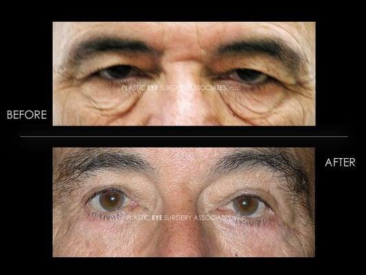 MALE BLEPHAROPLASTY