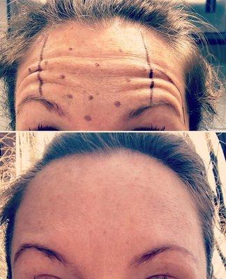 Botox Treatment before and after