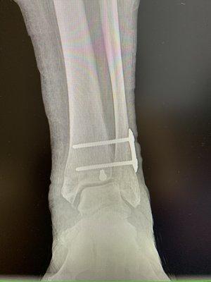 Ankle fracture fixation