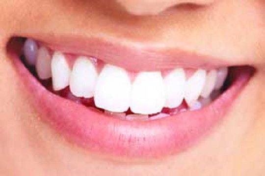 Teeth Whitening Santa Rosa