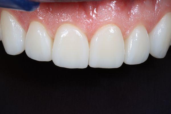 Here is our patient's "After" photo:
 1-Visit Veneers, Custom designed, custom stained, incredible! #DrNickDDS