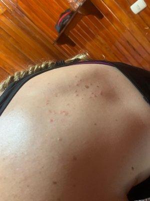 Huge cluster of bed bug bites on my back and shoulder.