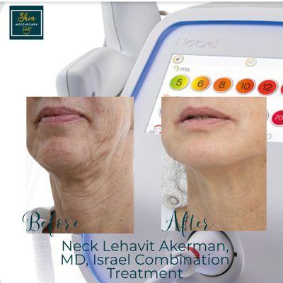 Skin Tightening - Neck Before & After