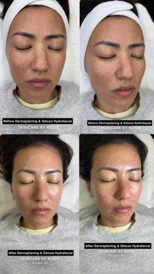 Dermaplaning & Deluxe Hydrafacial