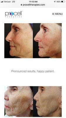 Collagen induction therapy that is less painful and you can go right back to work without that "Sunburned" feeling.