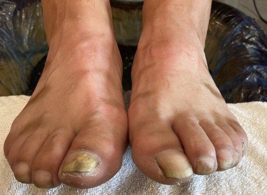 The ugly feet of an Ironworker.