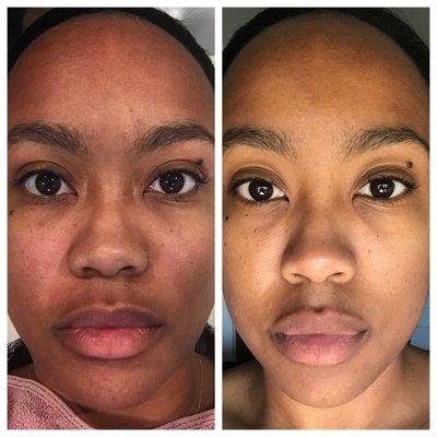 Before (left) and after (right) a single microdermabrasion treatment. Skintone is evened and pores appear smaller after just one treatment.