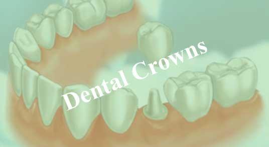 We do crowns and implant crowns here.  Call or stop by for a consultation.