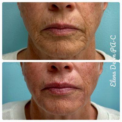 Elena Novak, PA-C used Versa to treat this patient's marionette lines, oral commissures, nasolabial folds, upper lip and chin area.