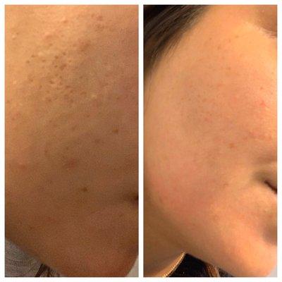 Before and After ONE Microneedling treatment !