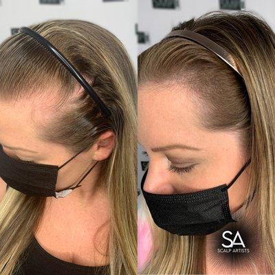 Scalp micropigmentation by Heidie