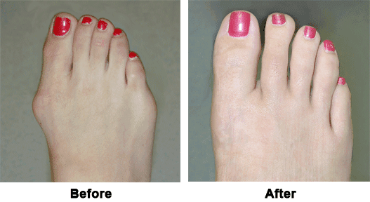 Before and After images from Bunion surgery.