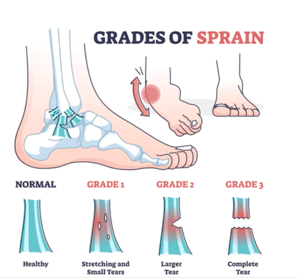 Grades of ankle sprain