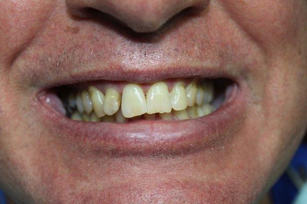 Before full mouth rehabilitation with combination of 28 single Emax Veneers and Zirconia crowns