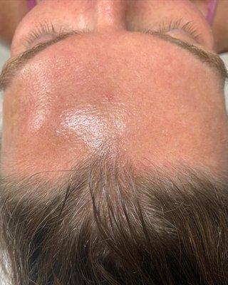 Microdermabrasion after