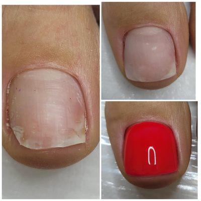 Toenail reconstruction