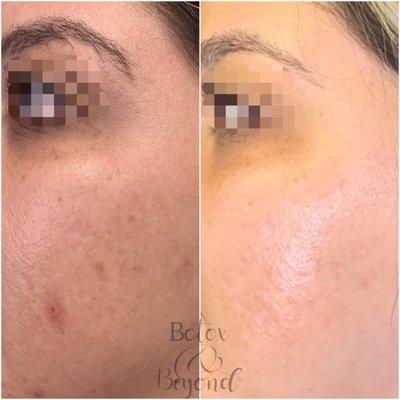 Laser acne treatment and microneedling with PRF