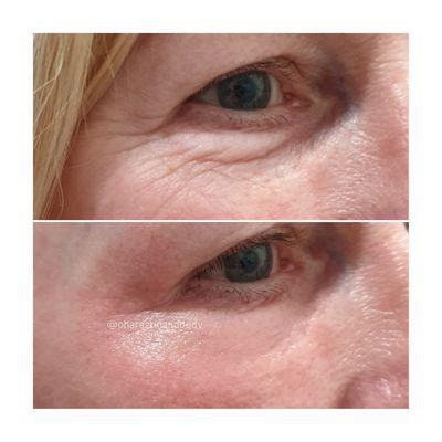 Before and after of the plasma fibroblast Skin Tightening treatment. Call for a free consultation 561-838-3077.