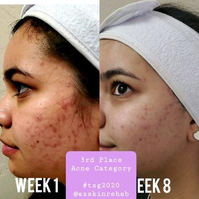 Acne treatment series for stunning results.