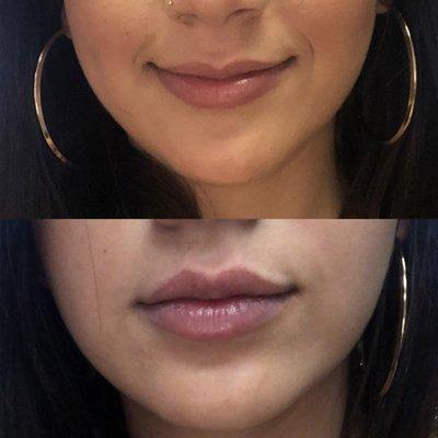 Lip augmentation. Actual Ten Years Younger client.