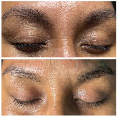 We treat and tighten the eye area!