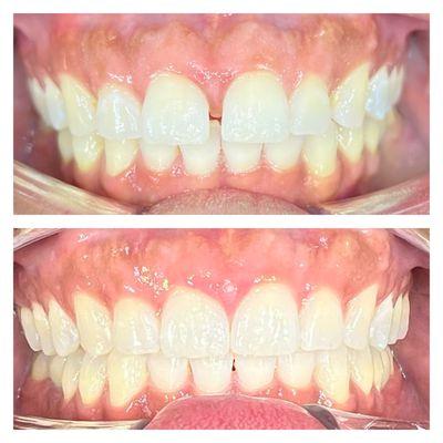 Another Invisalign case that took just under 9 months.  We were able to widen their smile and improve their occlusion.