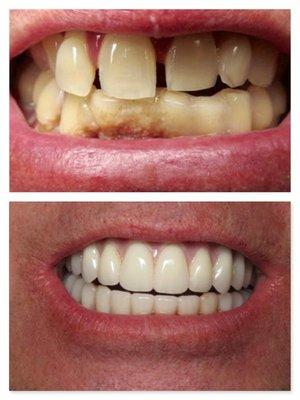 All-on-4 Dental Implants: Before & After