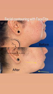 Submental fat (double chin)  reduction using radiofrequency