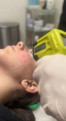 Laser Facials for acne!