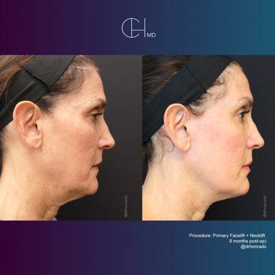 Primary Facelift + Neck Lift, 8 months post-op, performed by Dr. Carlo Honrado