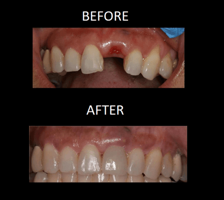 Dental implants can predictably replace missing teeth. Dr. Nguyen is a specialist with over 10 years experience.