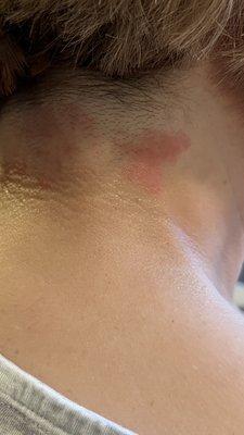 Clipper burns and painful abrasions