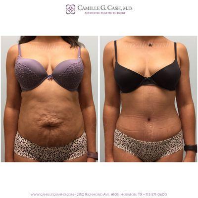 Before and 6 weeks after a tummy tuck with liposuction