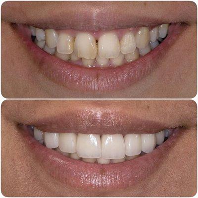 Smile transformation with porcelain veneers.