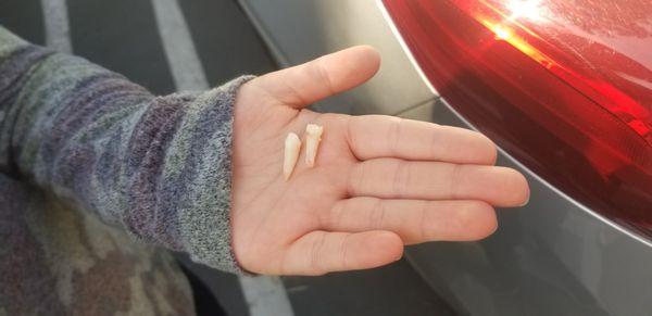 Biggest baby teeth I ever seen.