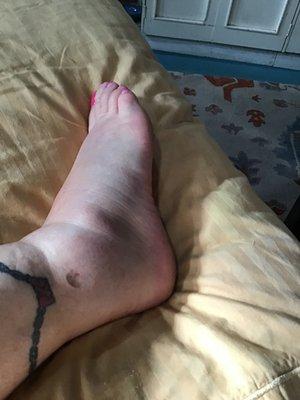 Fractured Fibula from assault in 
 "310 laundromat"